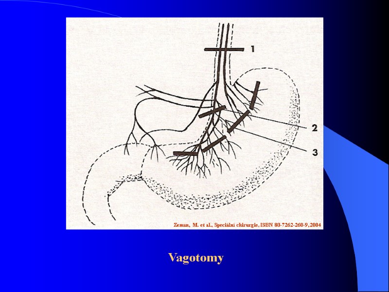 Zeman, M. et al., Speciální chirurgie, ISBN 80-7262-260-9, 2004 Vagotomy